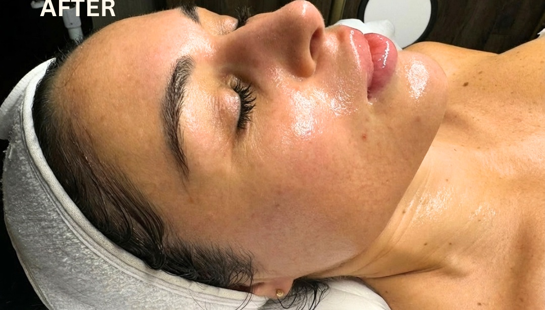 After: the same cheek and jaw after sculpting, more defined