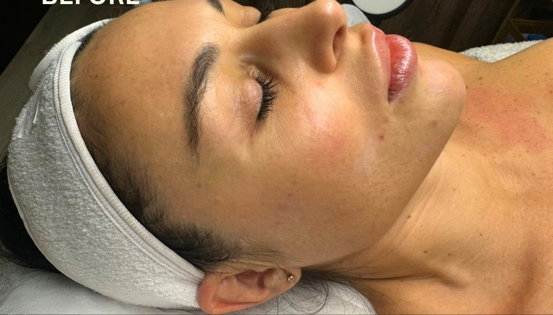 Before: a client's cheek and jaw before sculpting