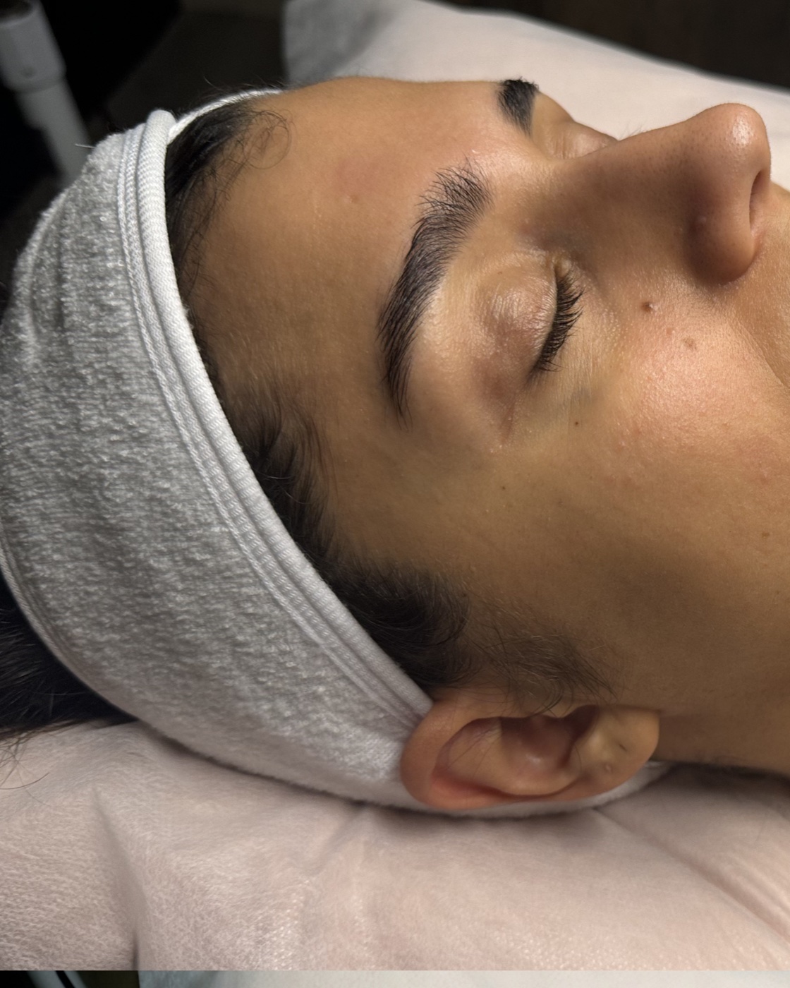 Before: side profile of a client's face and neck before a sculpting treatment